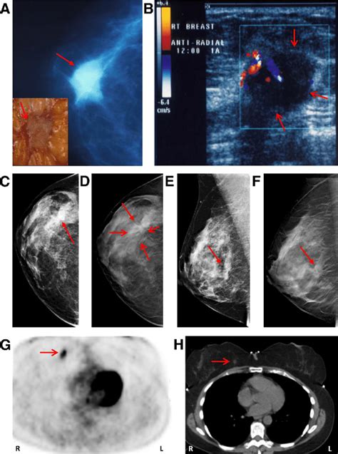 the villages breast cancer detection|Mammography and .